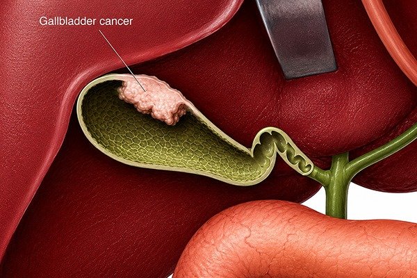 What is Gallbladder Cancer?