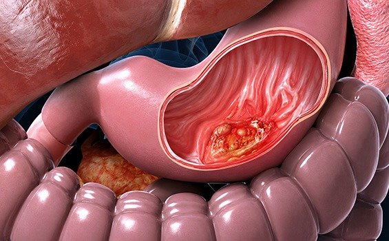 When to Consult a Doctor for Minimally Invasive GI Cancer Surgery?
