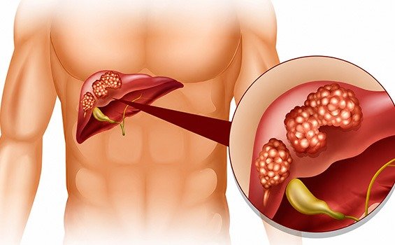 Who is an Ideal Candidate for Liver Cancer Surgery?