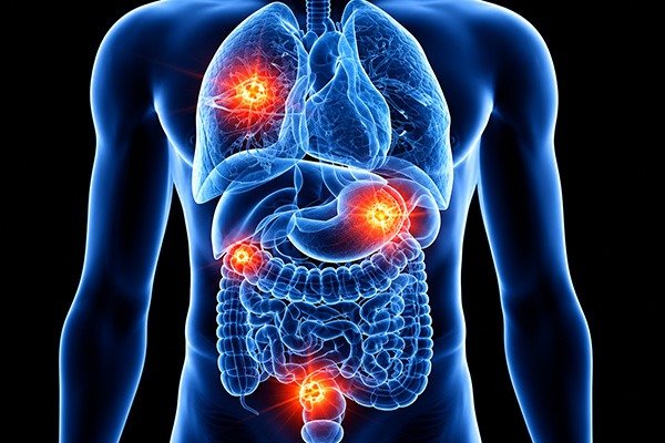 What Are the Benefits of Neuroendocrine Tumour Surgery?