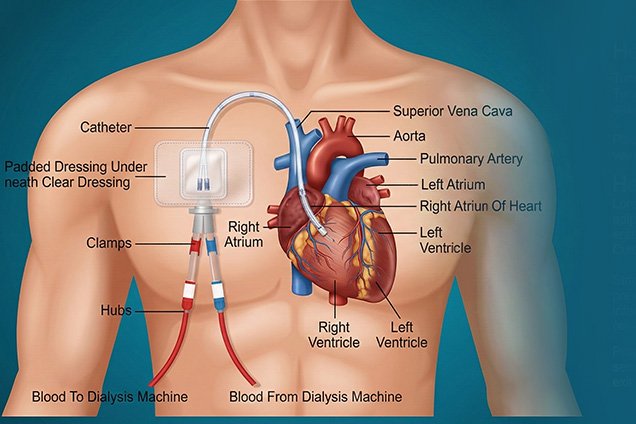 Chemo Port Insertion Procedure