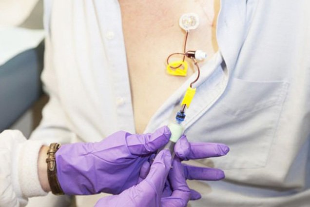 Risks & Complications of Chemo Port