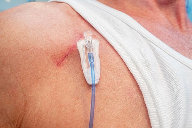 Sphincter Saving Surgery