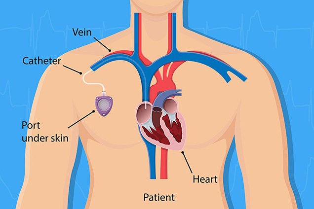Chemo Port Insertion