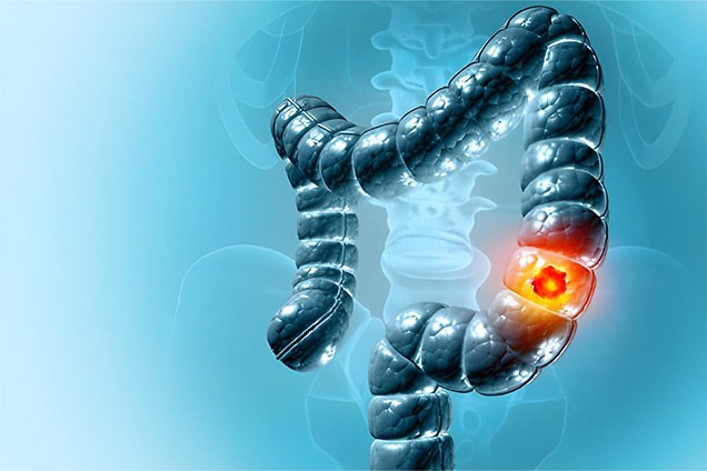 Laparoscopic Colorectal Surgery