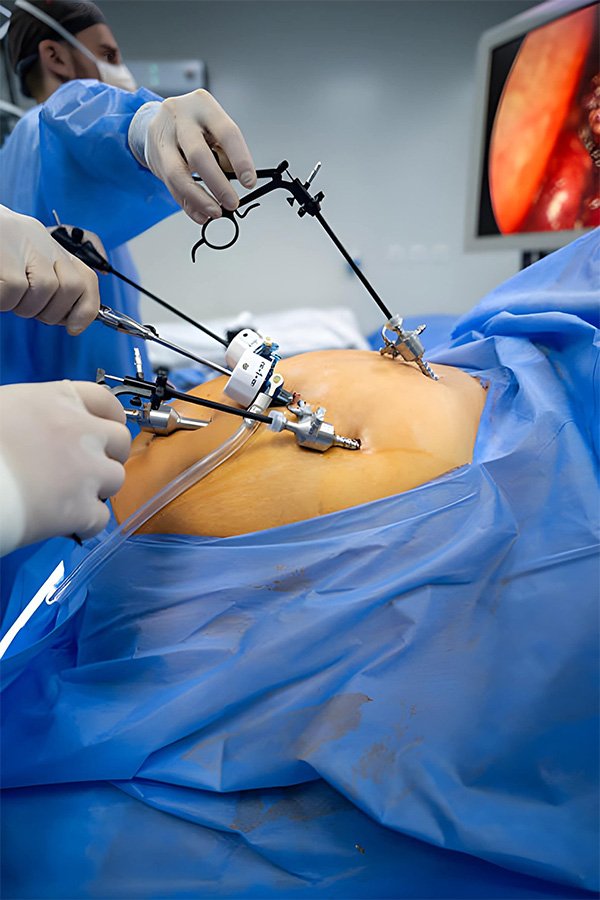 Laparoscopic Colorectal Surgery