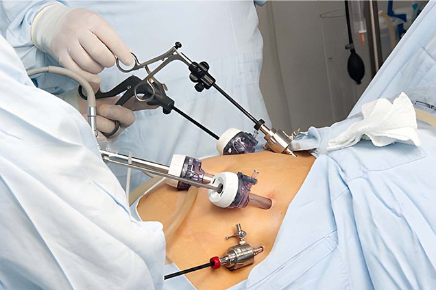 Laparoscopic Surgical Process