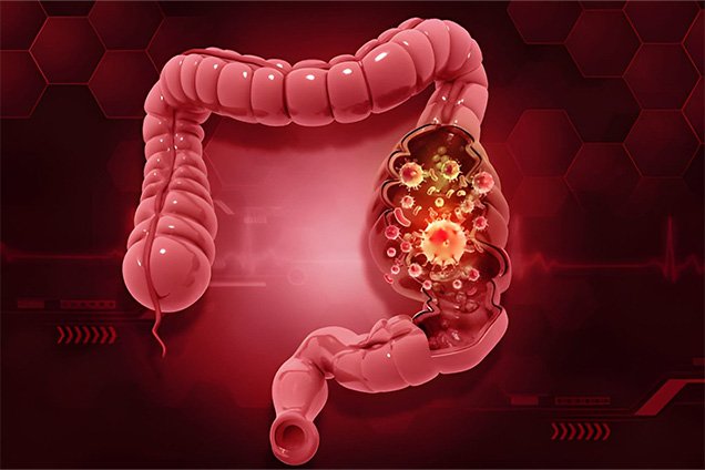 Types of Laparoscopic Colorectal Procedures