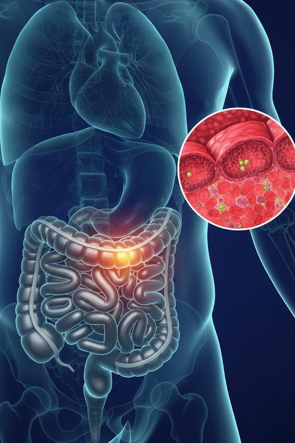 Retroperitoneal Sarcoma FAQ Image