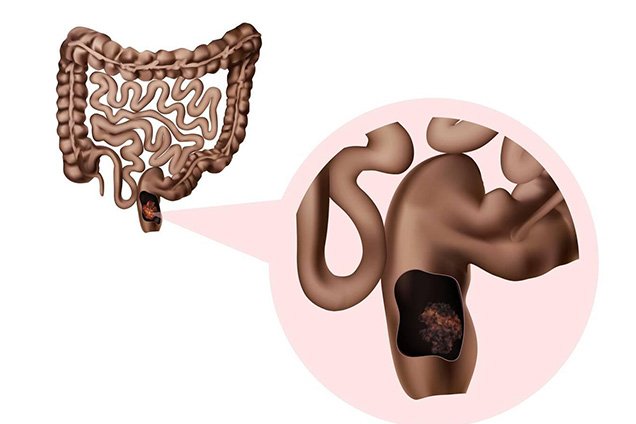 Sphincter Saving Surgery