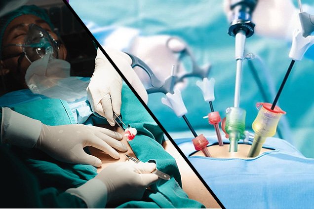 Open vs Laparoscopic Whipple Surgery
