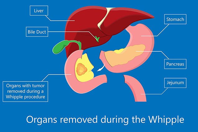 Whipple Surgery Procedure