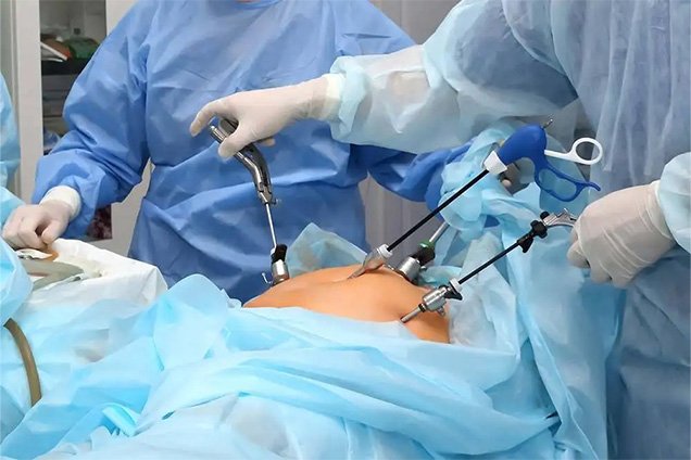 Laparoscopic Whipple Procedure